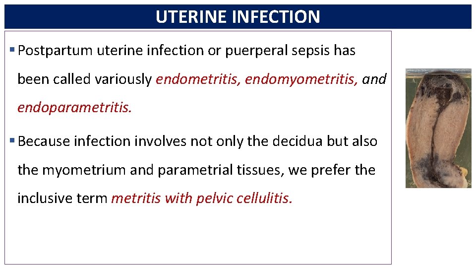 UTERINE INFECTION § Postpartum uterine infection or puerperal sepsis has been called variously endometritis,