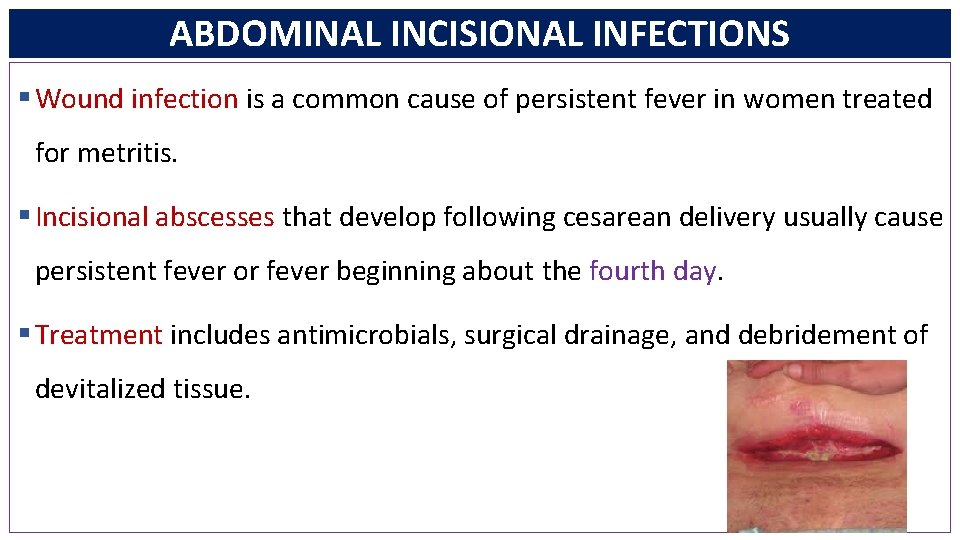 ABDOMINAL INCISIONAL INFECTIONS § Wound infection is a common cause of persistent fever in