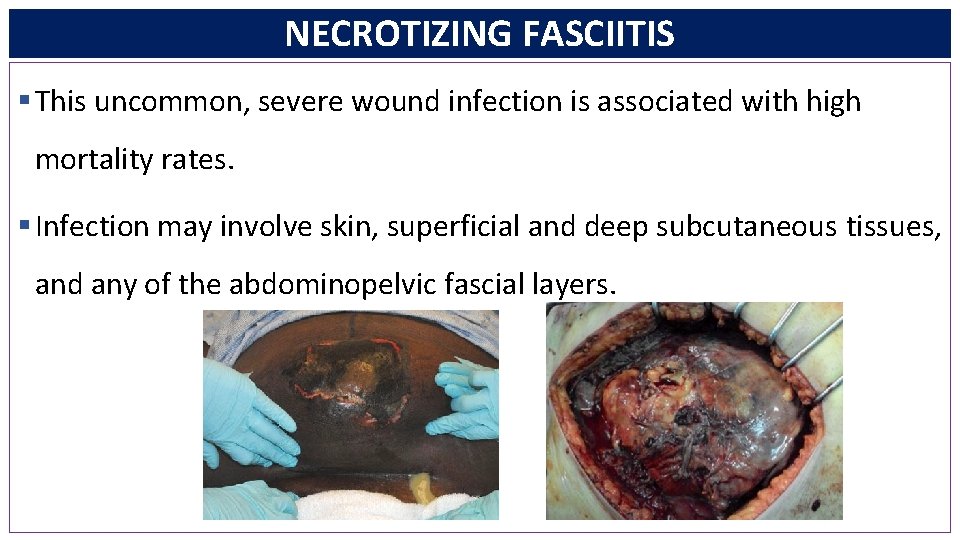 NECROTIZING FASCIITIS § This uncommon, severe wound infection is associated with high mortality rates.