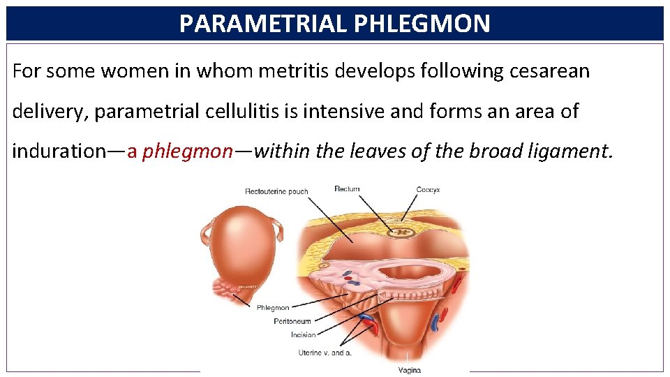 PARAMETRIAL PHLEGMON For some women in whom metritis develops following cesarean delivery, parametrial cellulitis