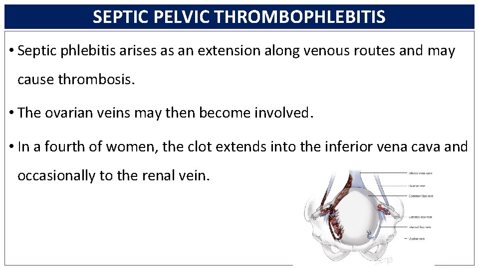 SEPTIC PELVIC THROMBOPHLEBITIS • Septic phlebitis arises as an extension along venous routes and