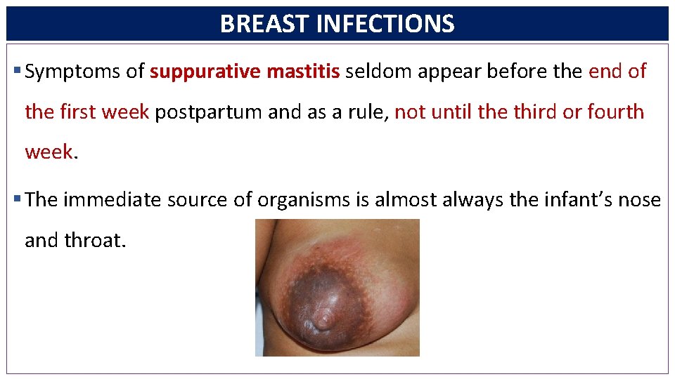 BREAST INFECTIONS § Symptoms of suppurative mastitis seldom appear before the end of the