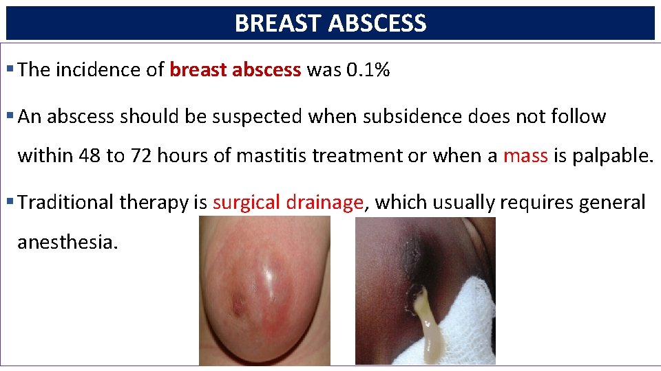 BREAST ABSCESS § The incidence of breast abscess was 0. 1% § An abscess