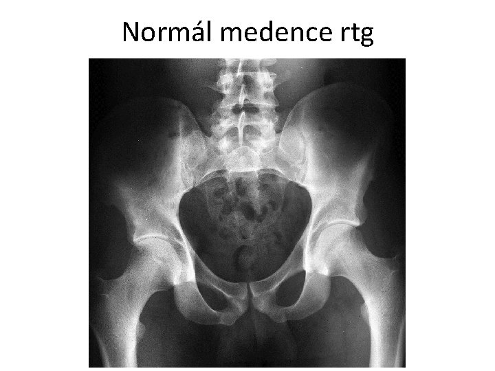 Normál medence rtg 