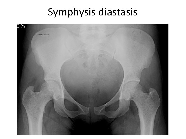 Symphysis diastasis 