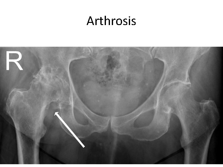 Arthrosis 