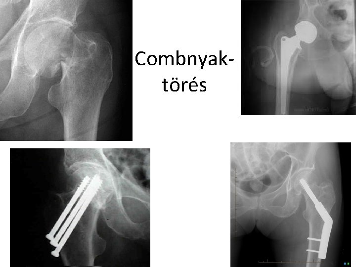 Combnyaktörés 