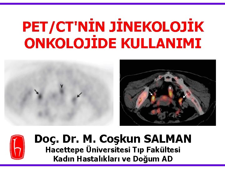 PET/CT'NİN JİNEKOLOJİK ONKOLOJİDE KULLANIMI Doç. Dr. M. Coşkun SALMAN Hacettepe Üniversitesi Tıp Fakültesi Kadın