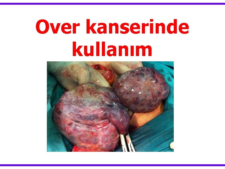 Over kanserinde kullanım 