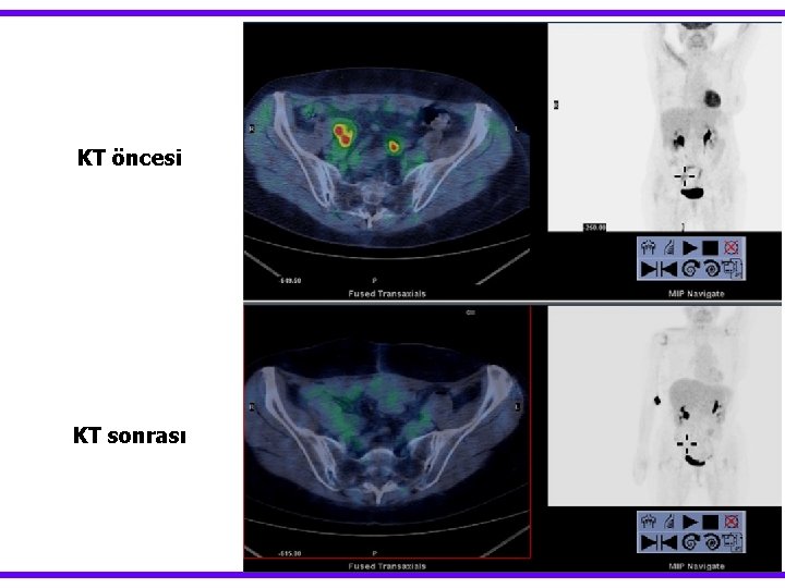 KT öncesi KT sonrası 