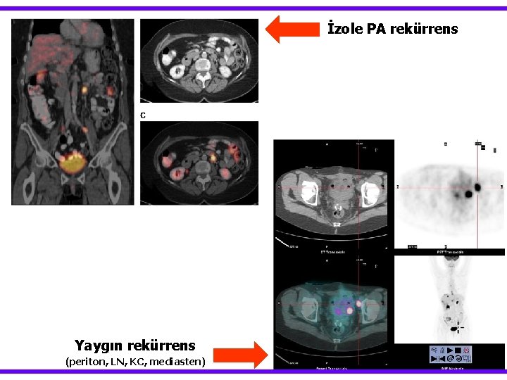 İzole PA rekürrens Yaygın rekürrens (periton, LN, KC, mediasten) 