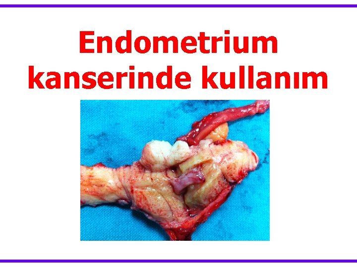 Endometrium kanserinde kullanım 
