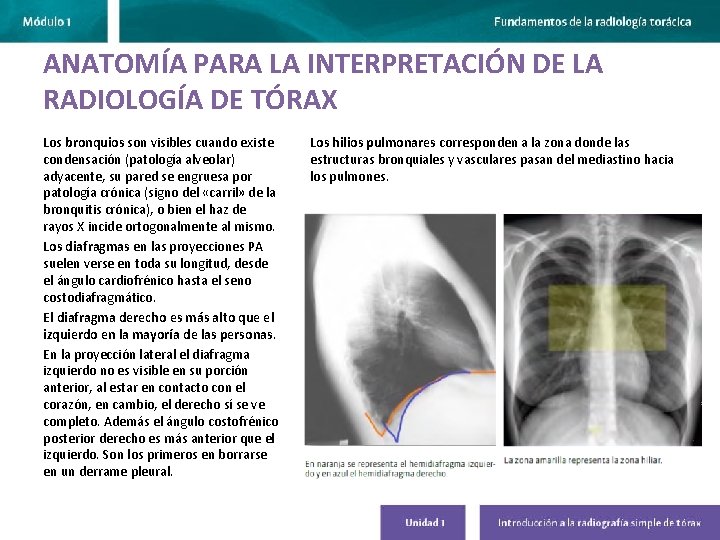 ANATOMÍA PARA LA INTERPRETACIÓN DE LA RADIOLOGÍA DE TÓRAX Los bronquios son visibles cuando