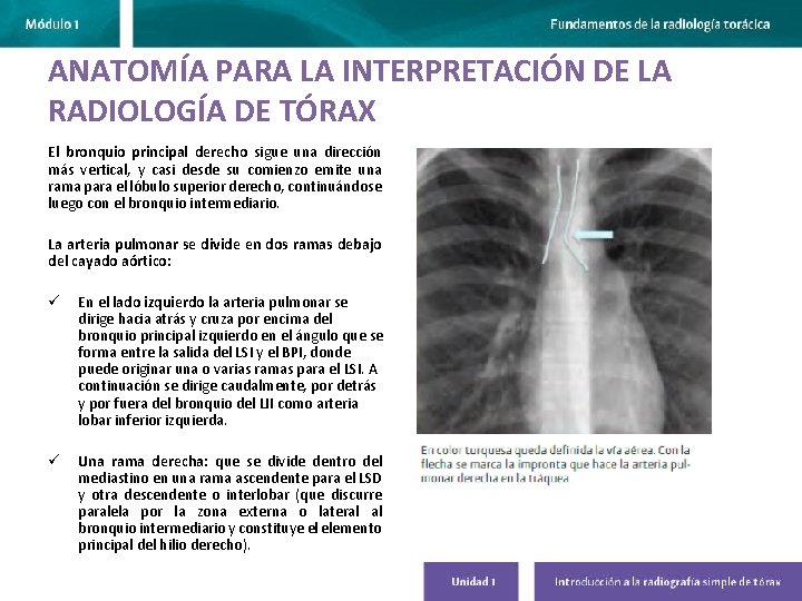 ANATOMÍA PARA LA INTERPRETACIÓN DE LA RADIOLOGÍA DE TÓRAX El bronquio principal derecho sigue
