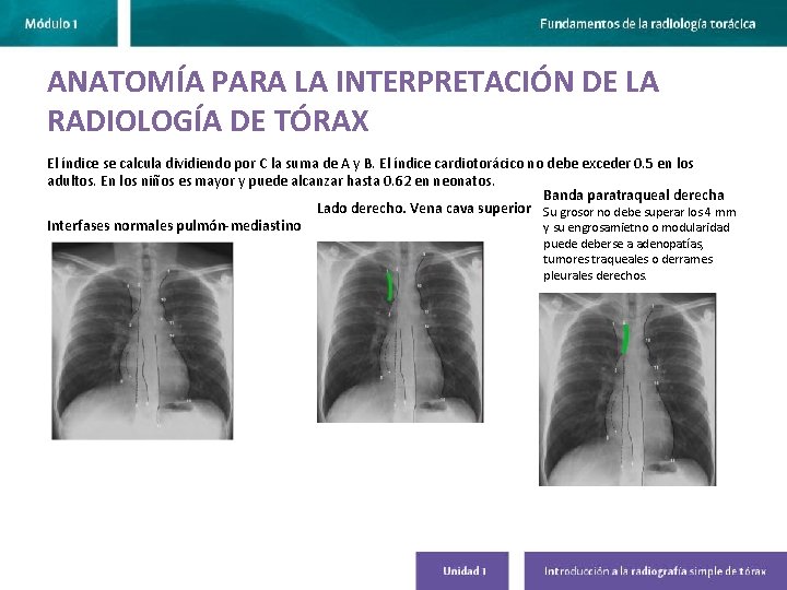 ANATOMÍA PARA LA INTERPRETACIÓN DE LA RADIOLOGÍA DE TÓRAX El índice se calcula dividiendo