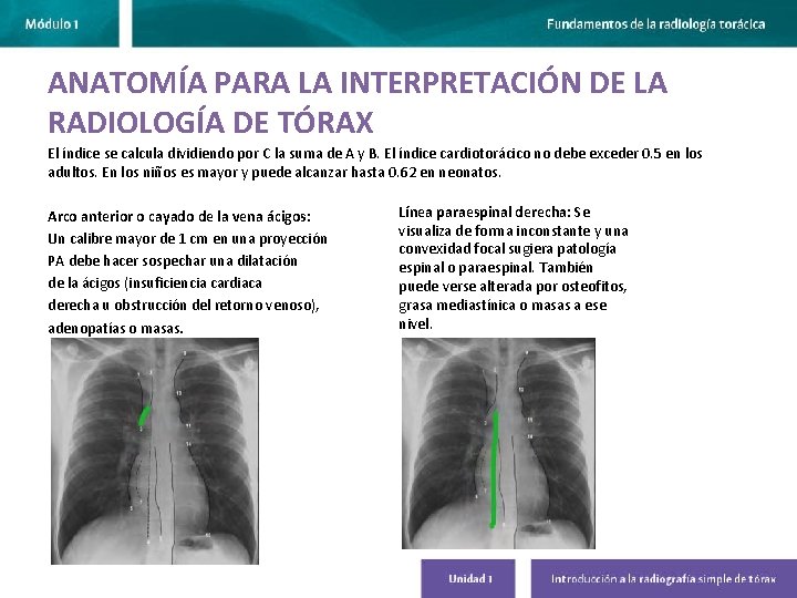 ANATOMÍA PARA LA INTERPRETACIÓN DE LA RADIOLOGÍA DE TÓRAX El índice se calcula dividiendo