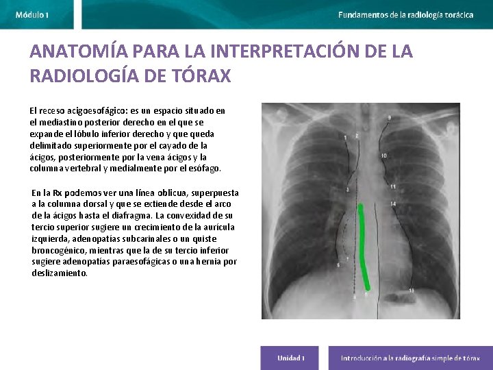 ANATOMÍA PARA LA INTERPRETACIÓN DE LA RADIOLOGÍA DE TÓRAX El receso acigoesofágico: es un