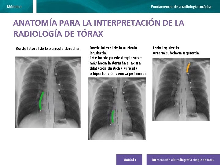ANATOMÍA PARA LA INTERPRETACIÓN DE LA RADIOLOGÍA DE TÓRAX Borde lateral de la aurícula