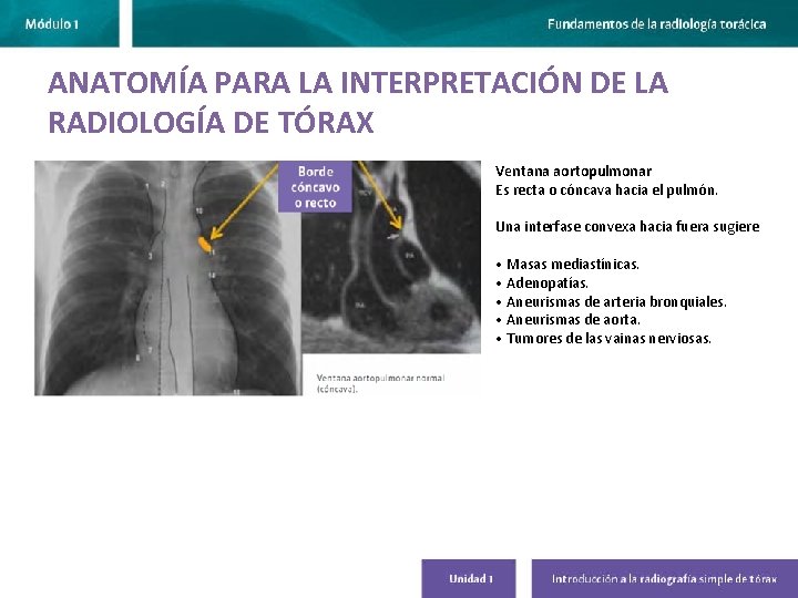 ANATOMÍA PARA LA INTERPRETACIÓN DE LA RADIOLOGÍA DE TÓRAX Ventana aortopulmonar Es recta o