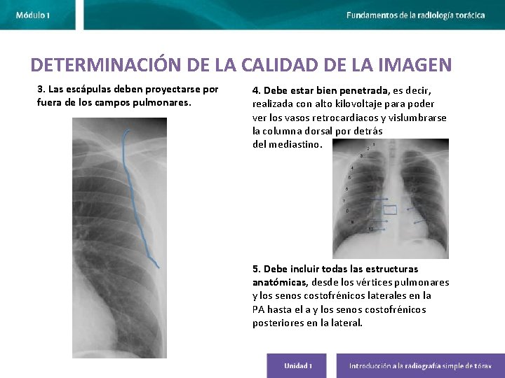 DETERMINACIÓN DE LA CALIDAD DE LA IMAGEN 3. Las escápulas deben proyectarse por fuera