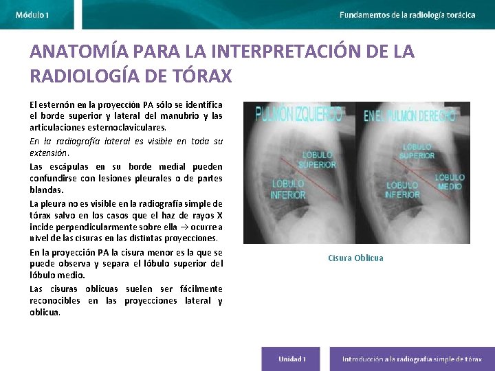 ANATOMÍA PARA LA INTERPRETACIÓN DE LA RADIOLOGÍA DE TÓRAX El esternón en la proyección