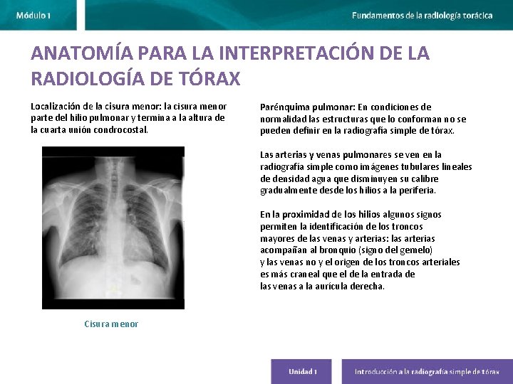 ANATOMÍA PARA LA INTERPRETACIÓN DE LA RADIOLOGÍA DE TÓRAX Localización de la cisura menor: