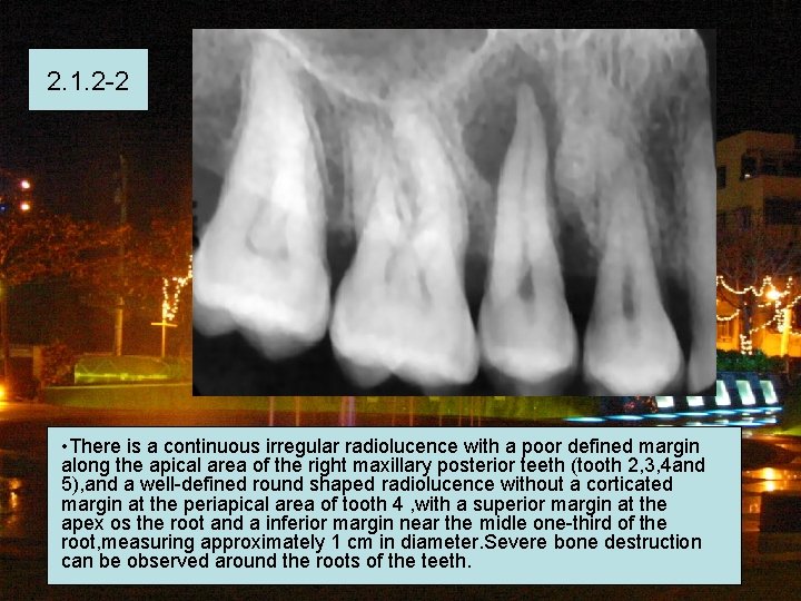 2. 1. 2 -2 • There is a continuous irregular radiolucence with a poor