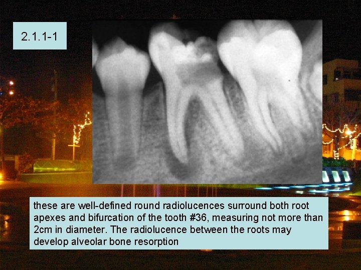 2. 1. 1 -1 these are well-defined round radiolucences surround both root apexes and