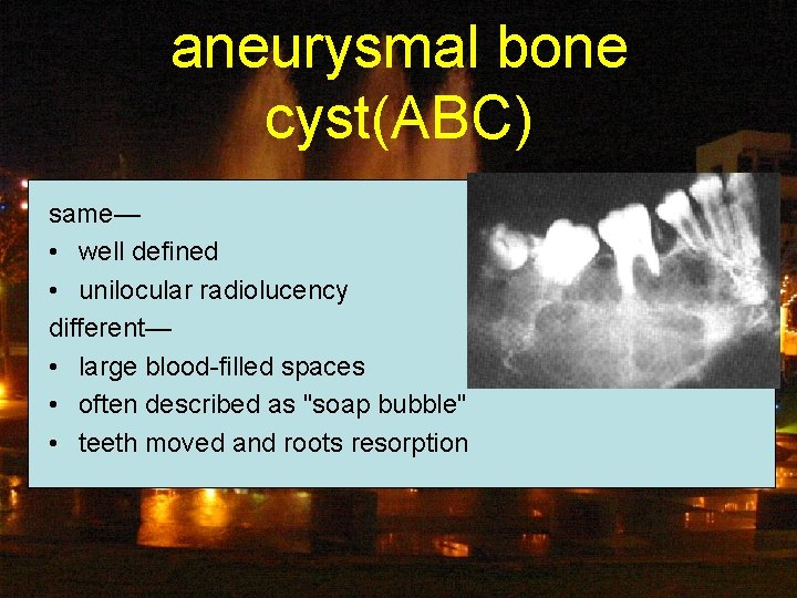 aneurysmal bone cyst(ABC) same— • well defined • unilocular radiolucency different— • large blood-filled