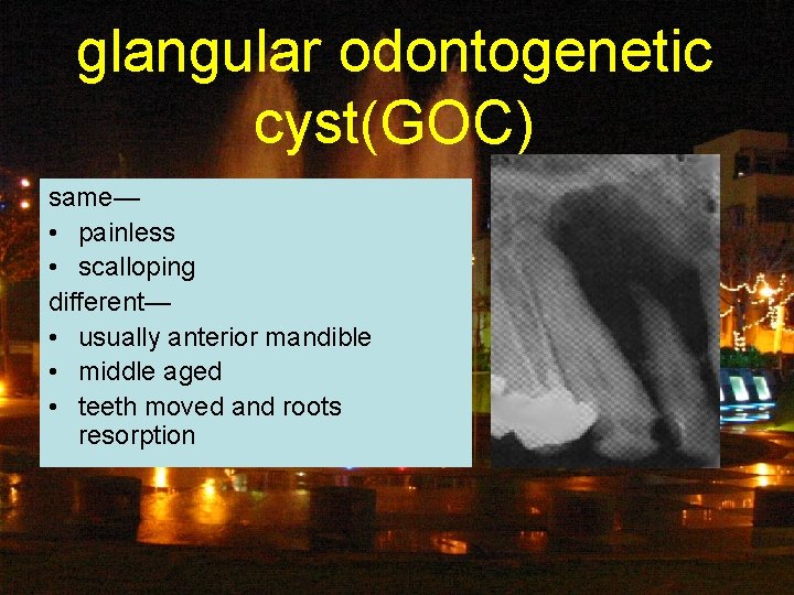 glangular odontogenetic cyst(GOC) same— • painless • scalloping different— • usually anterior mandible •
