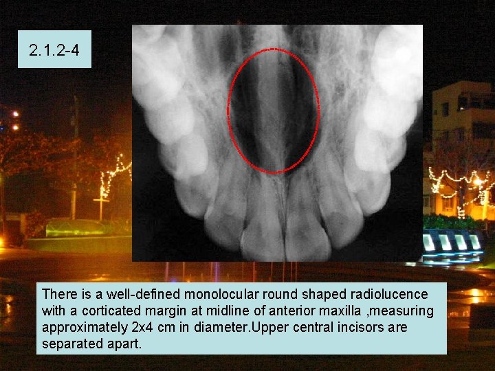 2. 1. 2 -4 There is a well-defined monolocular round shaped radiolucence with a