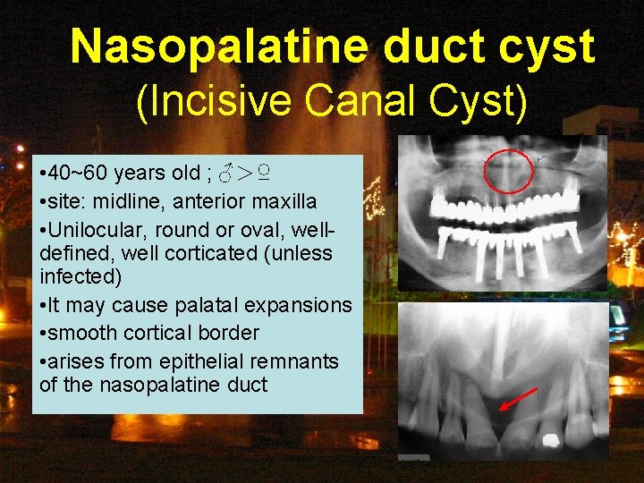 Nasopalatine duct cyst (Incisive Canal Cyst) • 40~60 years old ; ♂＞♀ • site: