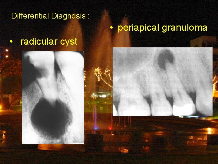 Differential Diagnosis : • periapical granuloma • radicular cyst 