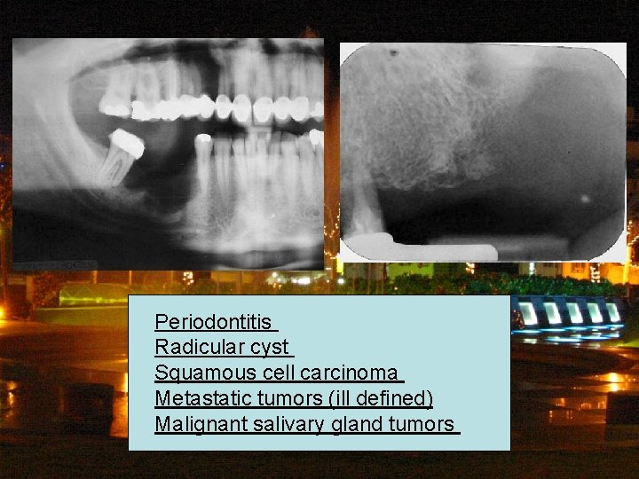 Periodontitis Radicular cyst Squamous cell carcinoma Metastatic tumors (ill defined) Malignant salivary gland tumors