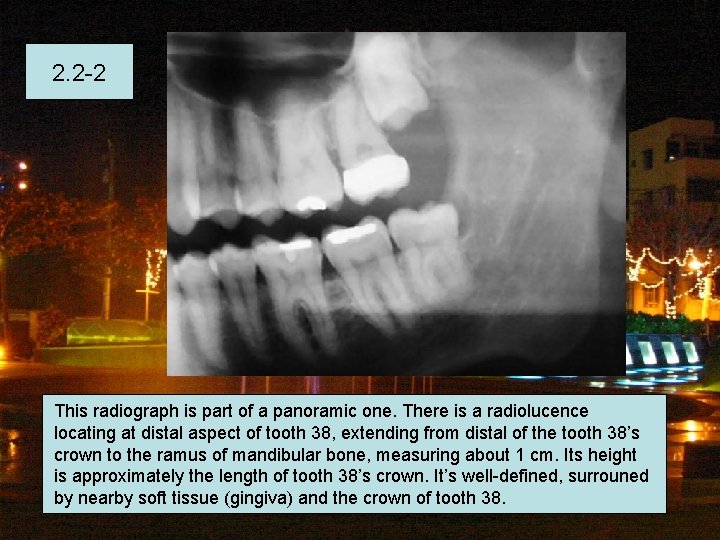 2. 2 -2 This radiograph is part of a panoramic one. There is a