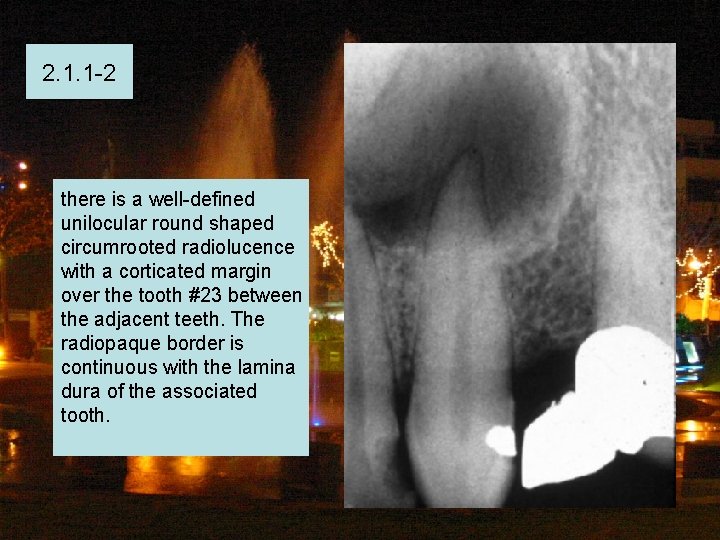 2. 1. 1 -2 there is a well-defined unilocular round shaped circumrooted radiolucence with