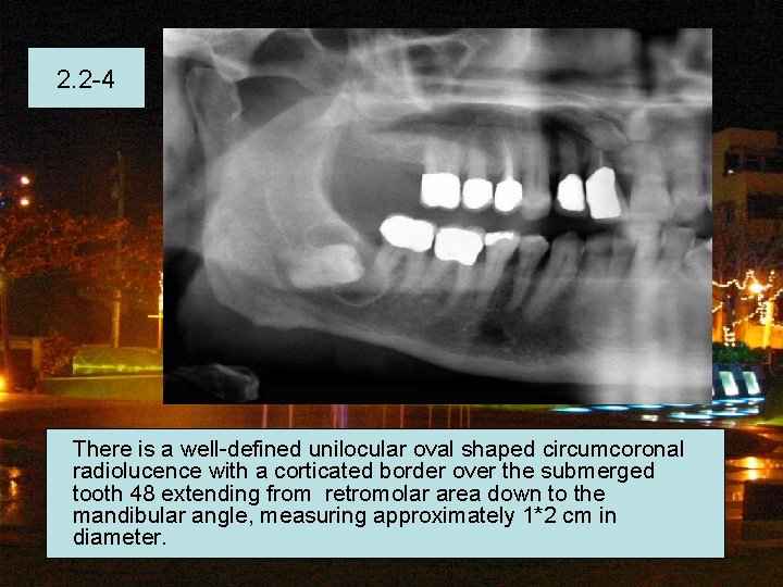 2. 2 -4 There is a well-defined unilocular oval shaped circumcoronal radiolucence with a