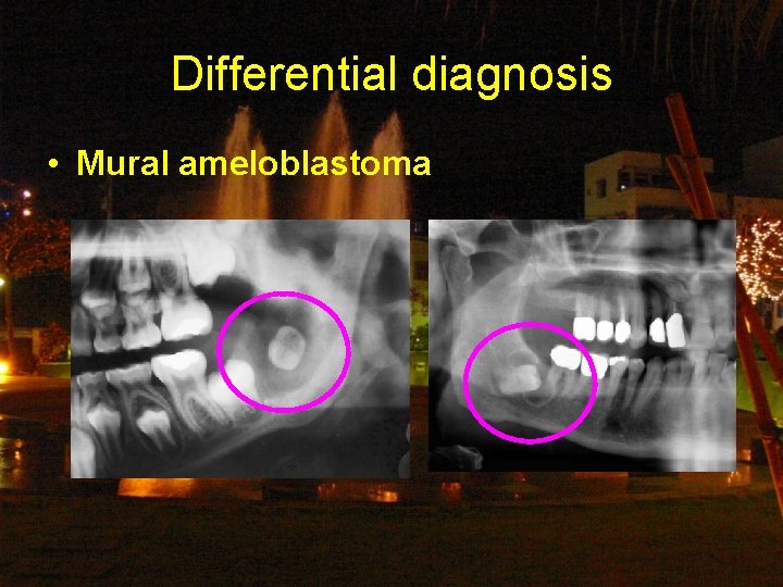 Differential diagnosis • Mural ameloblastoma 