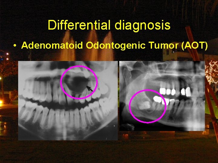 Differential diagnosis • Adenomatoid Odontogenic Tumor (AOT) 