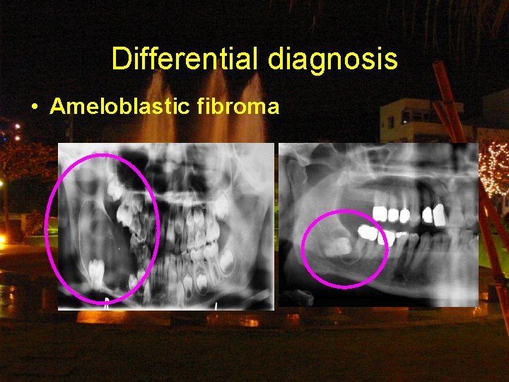 Differential diagnosis • Ameloblastic fibroma 