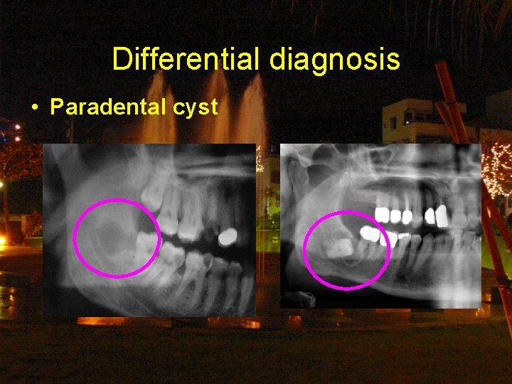 Differential diagnosis • Paradental cyst 