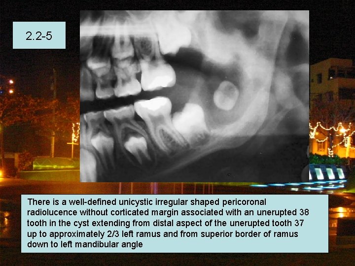 2. 2 -5 There is a well-defined unicystic irregular shaped pericoronal radiolucence without corticated