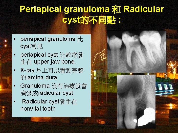 Periapical granuloma 和 Radicular cyst的不同點 : • periapical granuloma 比 cyst常見 • periapical cyst