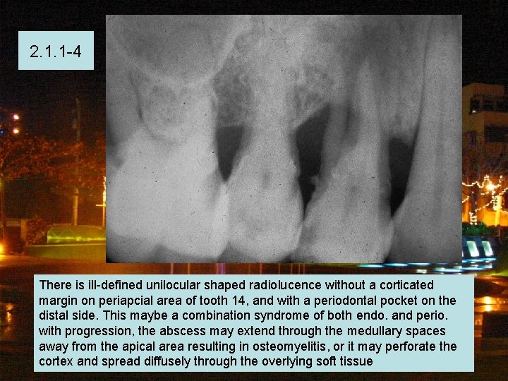 2. 1. 1 -4 There is ill-defined unilocular shaped radiolucence without a corticated margin