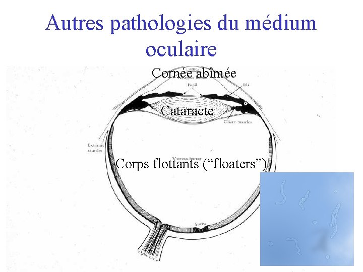 Autres pathologies du médium oculaire Cornée abîmée Cataracte Corps flottants (“floaters”) 