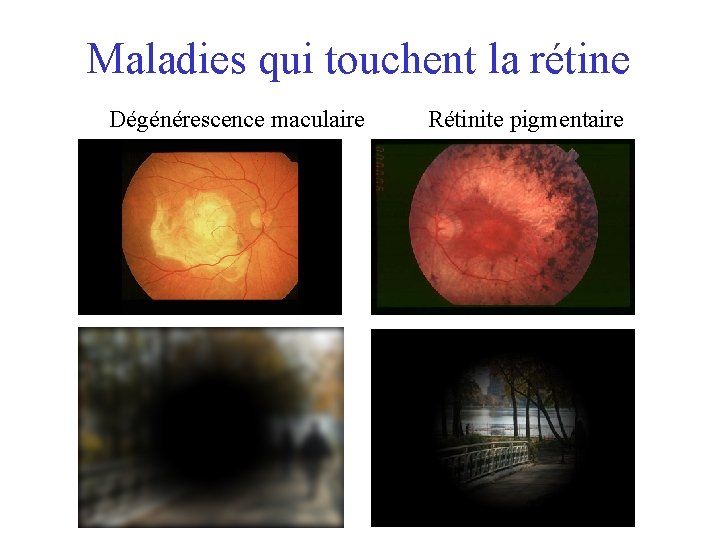 Maladies qui touchent la rétine Dégénérescence maculaire Rétinite pigmentaire 