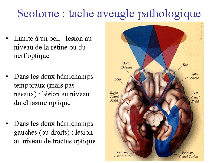Scotome : tache aveugle pathologique • Limité à un oeil : lésion au niveau