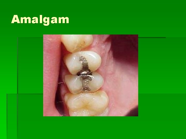 Amalgam 