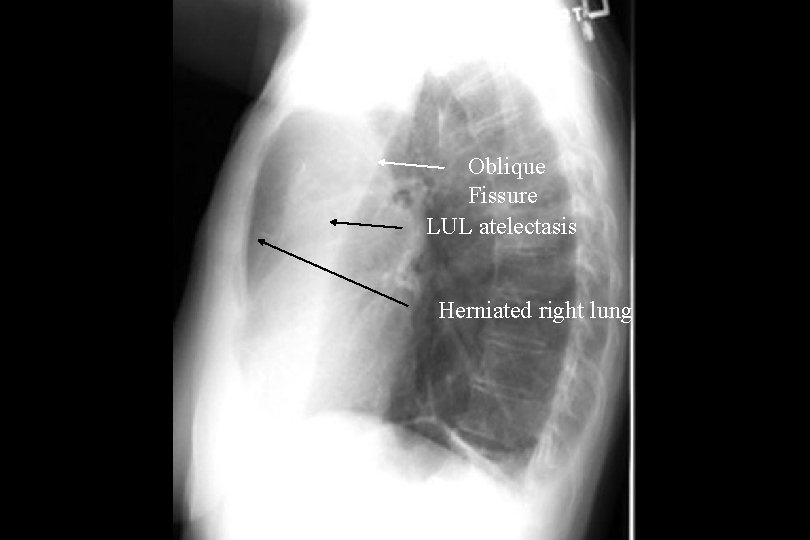 Oblique Fissure LUL atelectasis Herniated right lung 