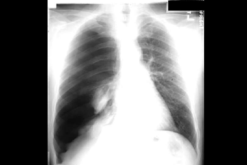 Pneumothorax Relaxation atelectasis Hydro-pneumo Large right hemithorax 